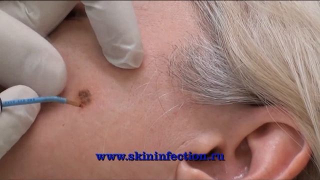 Удаление кератомы лица Палуха