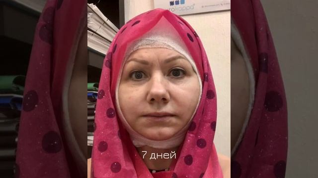 Реабилитация 14 дней после SMAS лифтинга. Как это выглядит. От и до