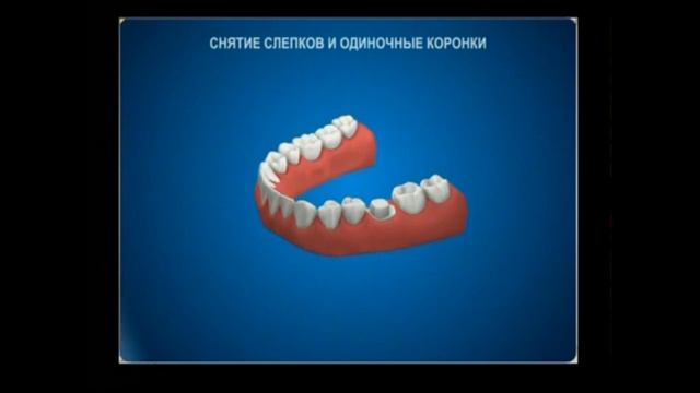 Изготовление одиночной коронки