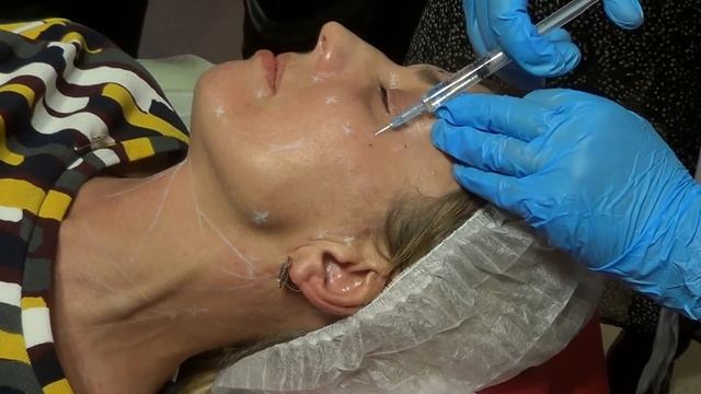 Мезотерапия лица DNA Lift