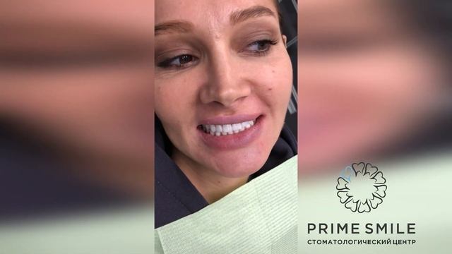 Результат установки керамических виниров спустя год
