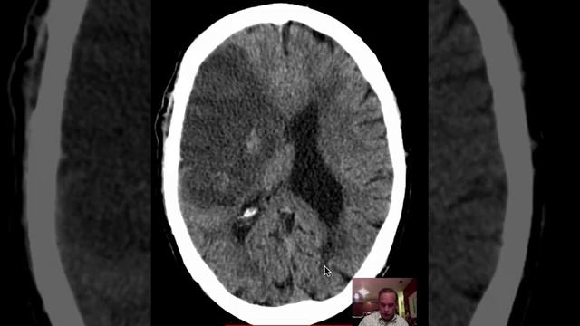 CT Head Anatomy w MCA Hem Stroke  DISCUSSION by Radiologist