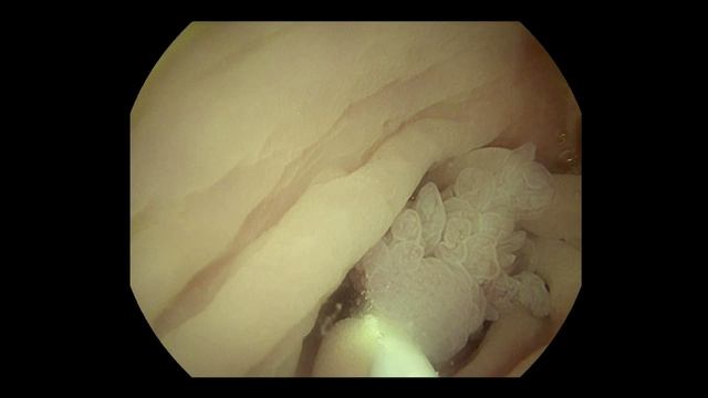 Подводная эндоскопическая резекция эпителиального новообразования (UEMR)