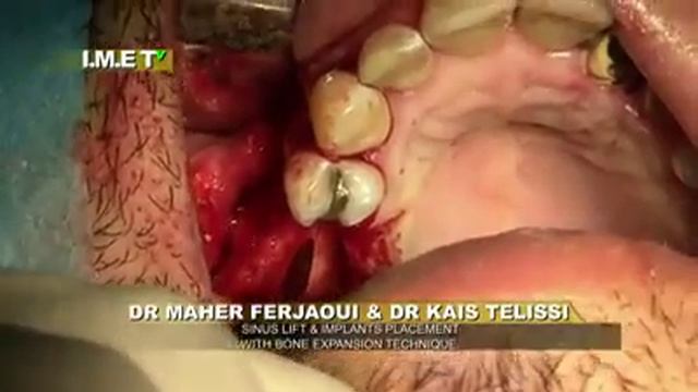 Sinus Lift and Implant Placement- Bone Expansion Technique .mp4