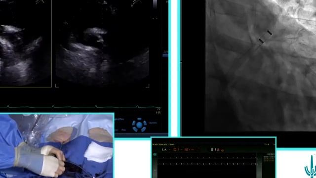 AcQCross™: Watchman Live Case 2 with AcQCross — Dr. Thomas Waggoner