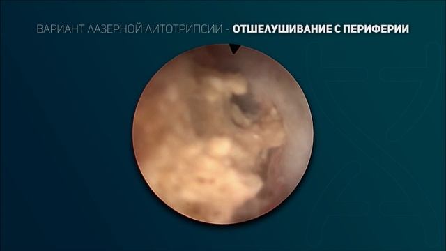 Лазерная литотрипсия. Видео 3.