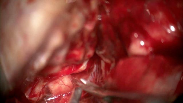 Артериальная аневризма бифуркации средней мозговой артерии