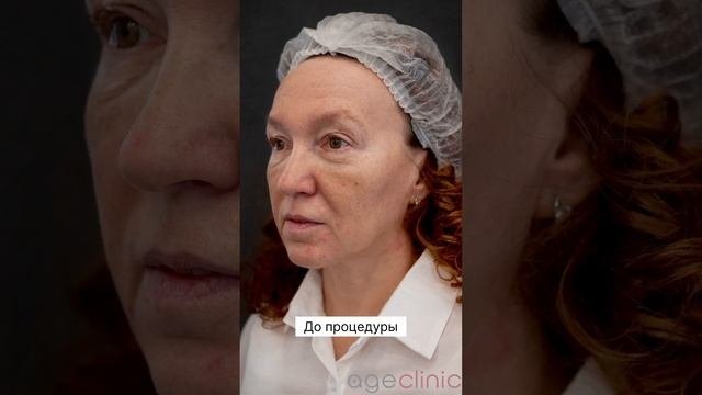 Результат процедуры Fullface