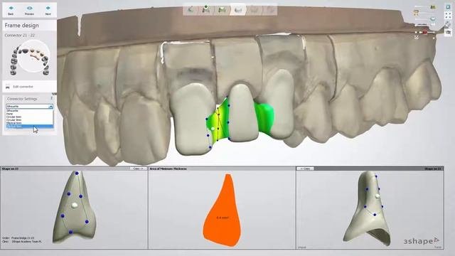 3Shape Dental System - Bridge Framework Design