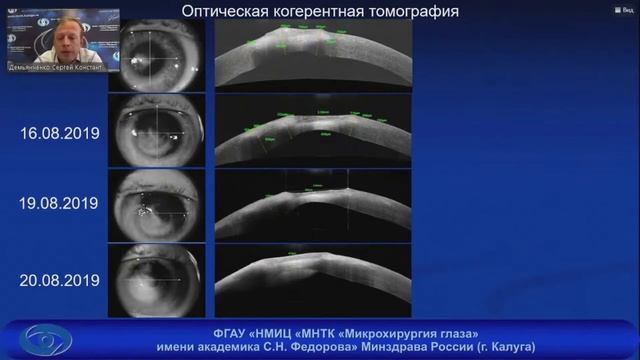 Язвы роговицы грибковой этиологии. Успехи и неудачи