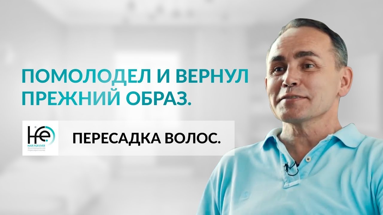 Пересадка волос. Реальная история спустя 7 лет!