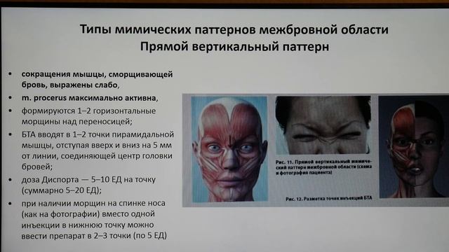 Токсин верх. Коррекция межбровъя(фрагмент).