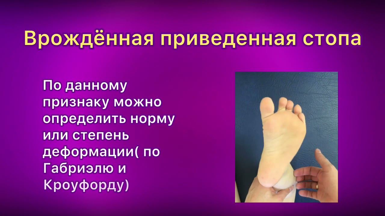 Врожденная приведенная стопа.