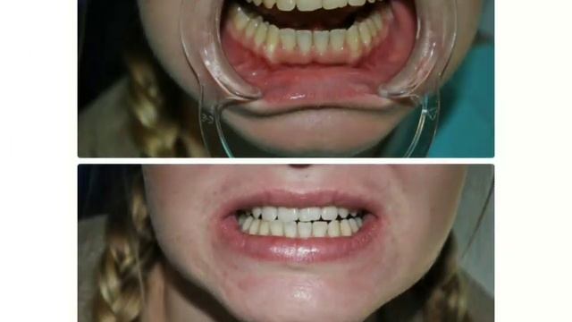 Кислородное отбеливание зубов. Smile ROOM