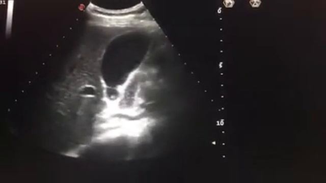 УЗИ желчного пузыря