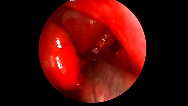 Эндоскопическая гайморотомия. Кистозный гайморит.