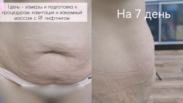 7 день: КАВИТАЦИЯ + ВАКУУМНЫЙ МАССАЖ С RF ЛИФТИНГОМ + КОНТРОЛЬ ПИТАНИЯ