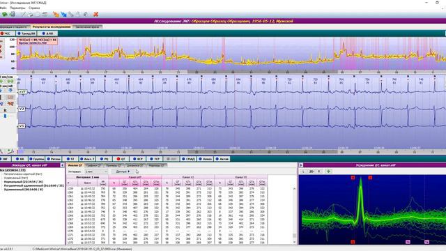WinIcar. Урок 06 - Интервалы ST, PQ, QT, Альтернация, Вариабельность, Турбулентность.