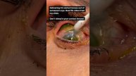 Офтальмолог из Калифорнии недавно удалила 23 контактные линзы у "очень забывчивого" пациента.