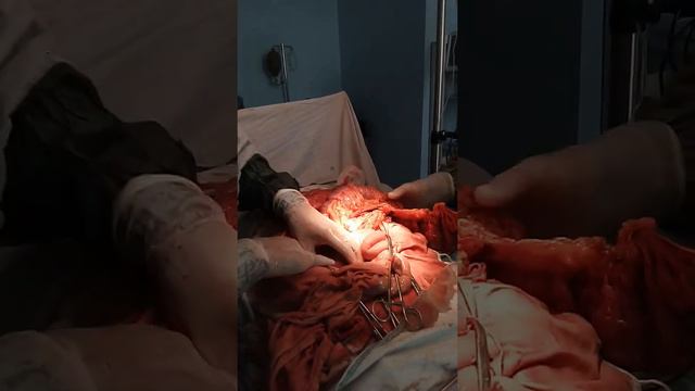 Субтотальная колэктомия.