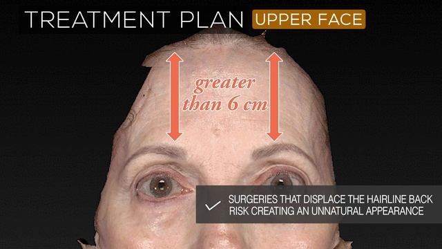 67 yo Female Brow Lift & Facelift | Aesthetic Minutes #BrowLift
