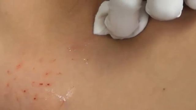 Lapatina anti cellulite