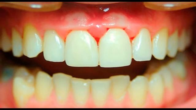 Dental  composite restoration