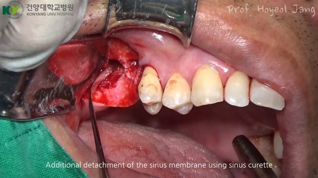 Crestal approach for maxillary sinus augmentation