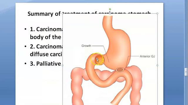 Surgery Stomach Carcinoma treatment GastroJejunostomy GJ Gastrectomy