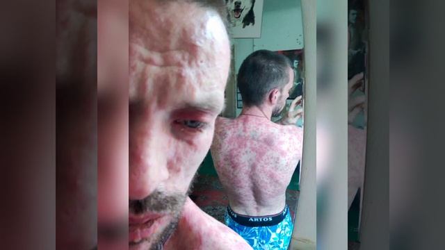 синдром Лайела во всей красе у взрослых