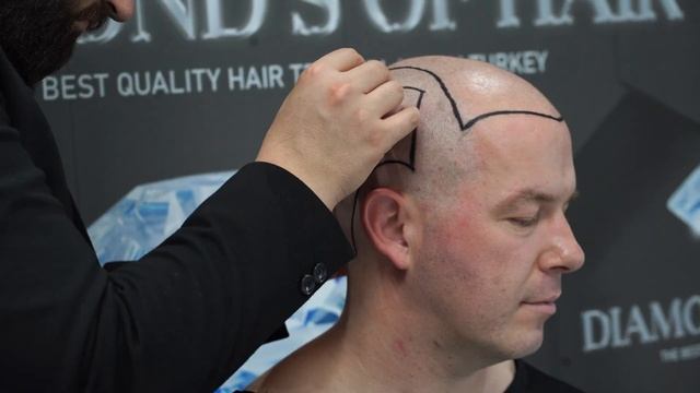 ALEKANDER'S HAARTRANSPLANTATIONS- REISE/AUS DEUTSCHLAND