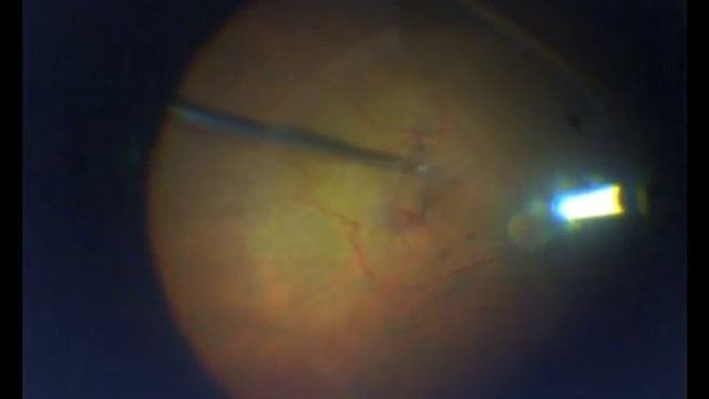Combined Phaco / 23G PPV For Severe Epimacular Traction Dr.Mishev Focus Eye Center