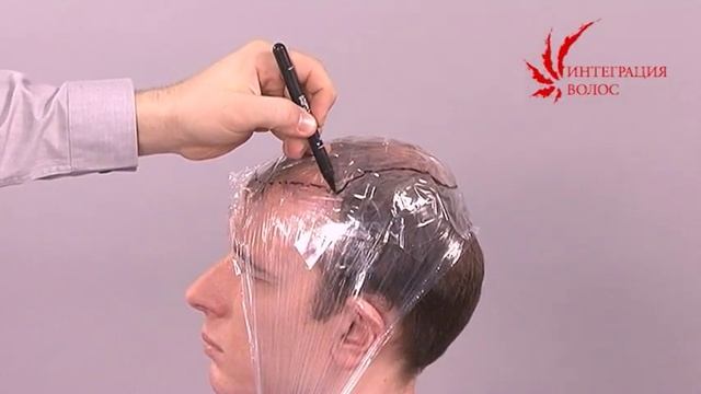 Крепление волосяного имплантата