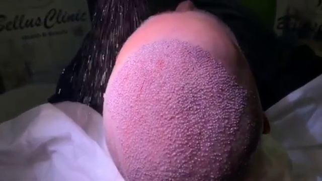 Пересадка волос, идеальная плотность пересадки в Bellus Clinic