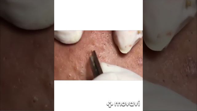 смачный прыщ
