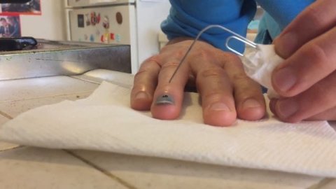 Smashed Fingernail Blood Draining: DIY Surgery
