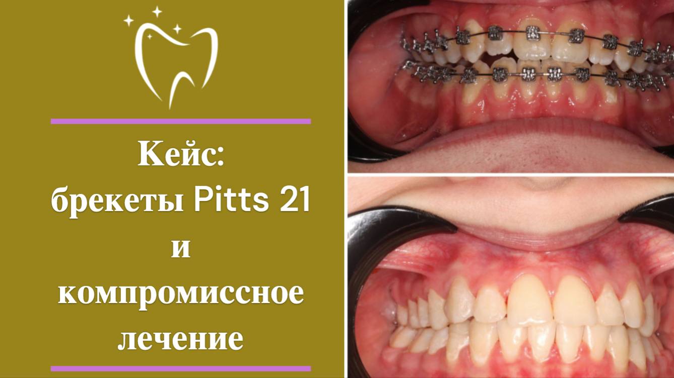 Кейс брекеты Pitts 21 и компромиссное  лечение