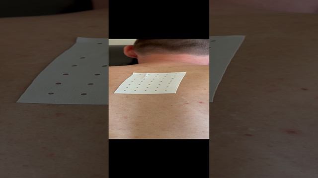 Здоровый позвоночник. Иглотерапия.