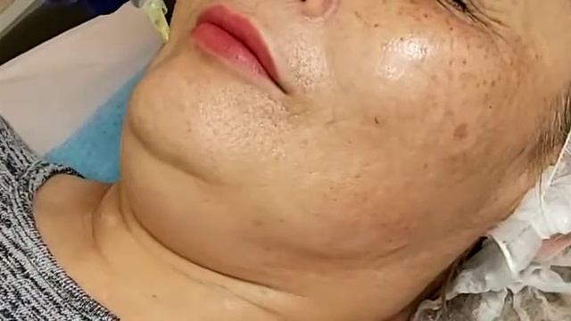 Мезотерапия для уменьшения подбородка и области брыль.