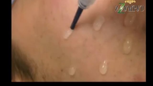 лазерная биоревитализация