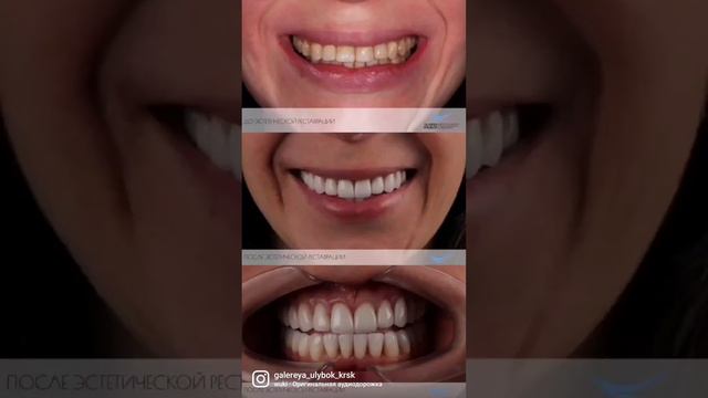30 счастливых улыбок #allon4 #astratech #straumann #всена4  #протезированиезубов #стоматологхирург