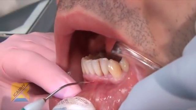Применение диодного лазера FERRERA-DENTSTAL  в стоматологии
