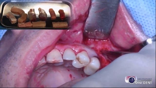 Sinus lifting