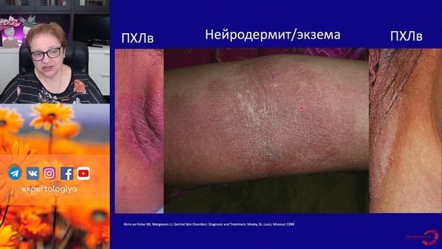 Простой хронический лихен l Пустотина О.А.