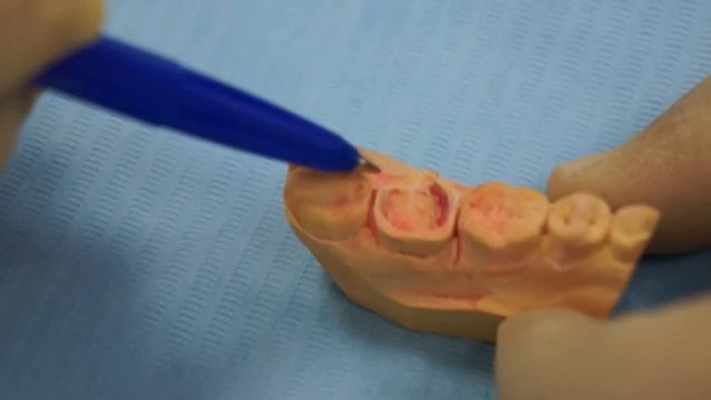 Вкладка вместо коронки