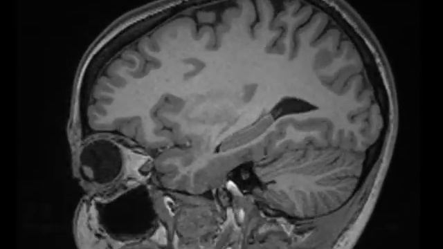 Brain MRI: T1 "relaxation"