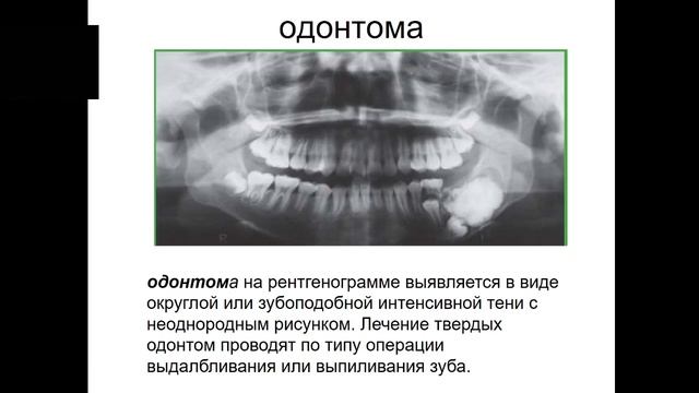 07.11.23 Лекция №6 Доброкачественные и злокачественные опухоли челюстно-лицевой области