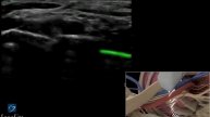 3D-пособие: Блокада надключичного нерва под контролем ультразвука -- ультразвуковая система SonoSit
