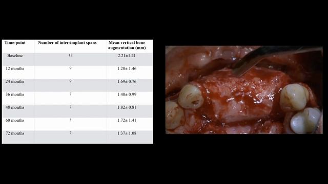 Evolution of bone regenerative protocols w/ Federico Hernández-Alfaro & Istvan Urban | EAO Congress