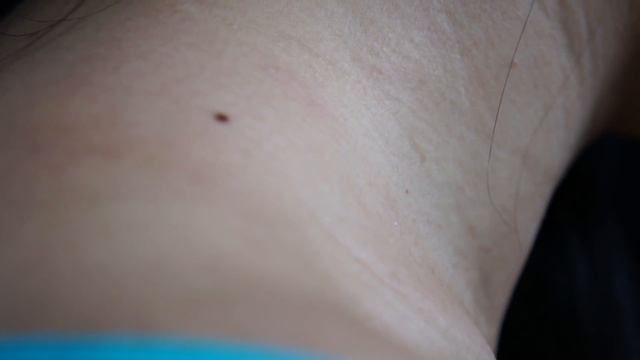 ASMR SKIN CHECK UP - MOLE BEAUTY MARK EXAMINATION  REMOVAL !! practice lol